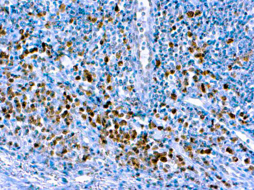 Formalin fixed paraffin embedded human tonsil stained with Caspase 3/CPP32