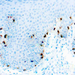 Formalin fixed paraffin embedded human melanoma stained with Tyrosinase antibody.
