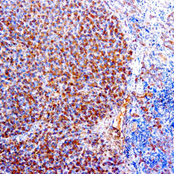 Formalin fixed paraffin embedded human hepatosarcoma stained with α-1-Antitrypsin