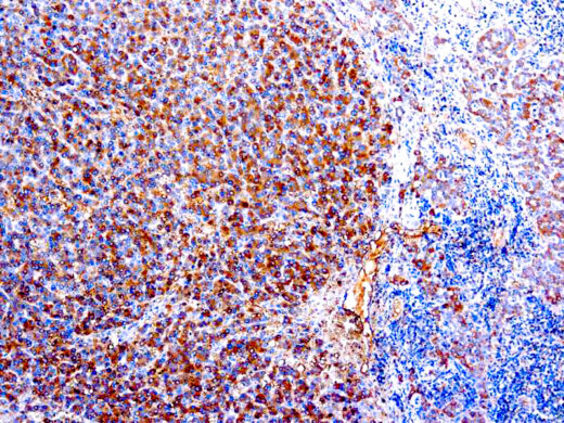 Formalin fixed paraffin embedded human hepatosarcoma stained with α-1-Antitrypsin