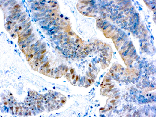 Formalin fixed paraffin embedded ovarian cancer stained with BRCA1