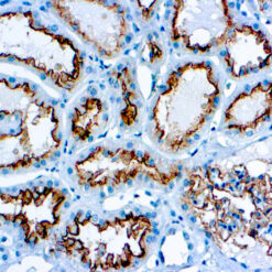 Formalin fixed paraffin embedded renal cell carcinoma stained with CD10
