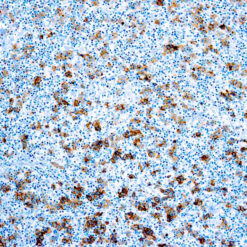 Formalin fixed paraffin embedded human Hodgkin’s Lymphoma stained with CD30 antibody