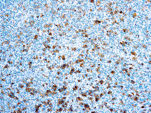 Formalin fixed paraffin embedded human Hodgkin’s Lymphoma stained with CD30 antibody