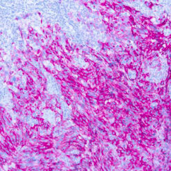 Formalin fixed paraffin embedded human melanoma stained with Melanoma antibody