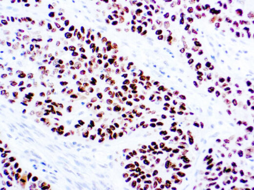 Formalin fixed paraffin embedded human lung squamous cell carcinoma stained with p40 antibody.