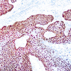 Formalin fixed paraffin embedded huma lung squamous cell carcinoma stained with p63 antibody.