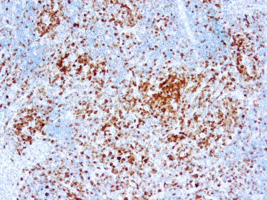 Formalin fixed paraffin embedded anaplastic lymphoma kinase stained with ALK/p80