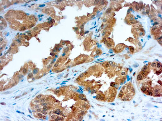 Formalin fixed paraffin embedded human prostate carcinoma stained with Galectin-3.