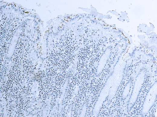 Formalin fixed paraffin embedded human infected tissue stained with H.pylori.