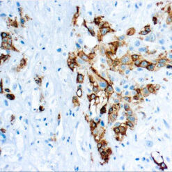 Formalin fixed paraffin embedded mesothelioma stained with Mesothelin.