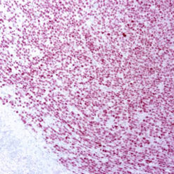 Formalin fixed paraffin embedded human melanoma stained with PRAME
