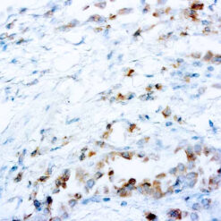 Formalin fixed paraffin embedded human Lung carcinoma stained with ROS1
