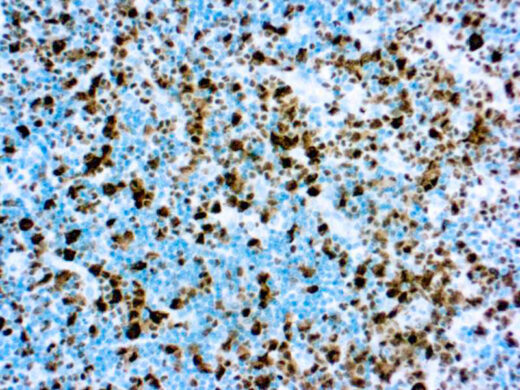 Formalin fixed paraffin embedded rhabdomyosarcoma stained with ALK