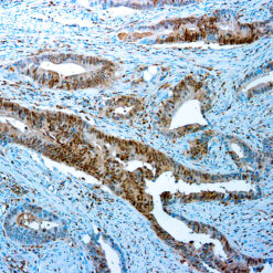 Formalin fixed paraffin embedded human Colon Ca stained with Smad4.
