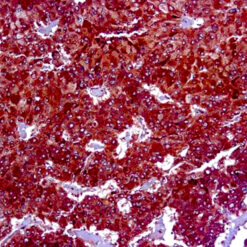 Formalin fixed paraffin embedded adrenal carcinoma stained with Adipophlin