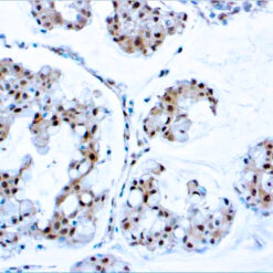Formalin fixed paraffin embedded human breast carcinoma stained with PTEN antibody.