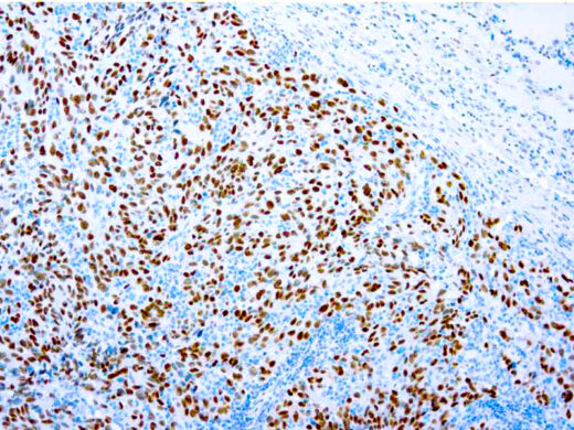 Formalin fixed paraffin embedded human melanoma stained with SOX-10 antibody