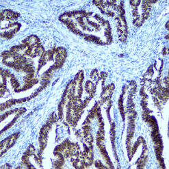 Formalin fixed paraffin embedded colon carcinoma stained with CDX2 antibody.