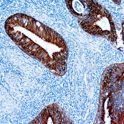 Formalin fixed paraffin embedded human lung squamous cell carcinoma stained with Cytokeratin AE1 antibody.