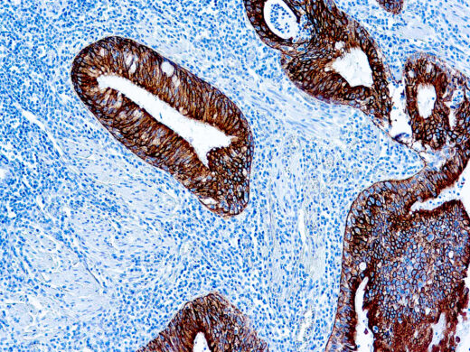Formalin fixed paraffin embedded human lung squamous cell carcinoma stained with Cytokeratin AE1 antibody.