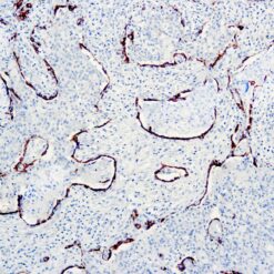 Formalin fixed paraffin embedded human lung squamous cell carcinoma stained with Cytokeratin AE1/AE3.