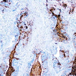 Formalin fixed paraffin embedded colon carcinoma stained with TAG-72 antibody.