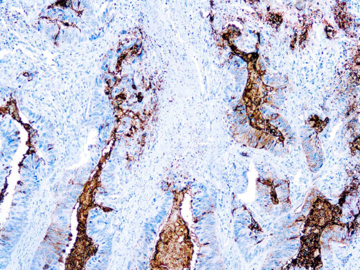 Formalin fixed paraffin embedded colon carcinoma stained with TAG-72 antibody.