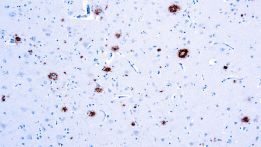 Formalin fixed paraffin embedded amyloidosis stained with β-Amyloid Protein