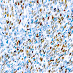 Formalin fixed paraffin embedded rhabdomyosarcoma stained with MyoD1 antibody