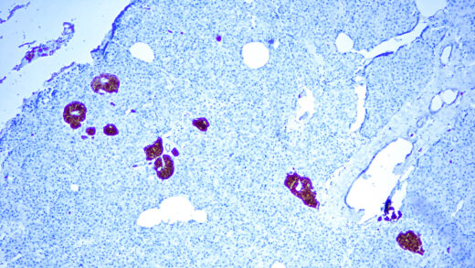 Formalin fixed paraffin embedded human Pancreas stained with NSE