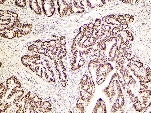 Formalin fixed paraffin embedded colon adenocarcinoma stained with PMS2.