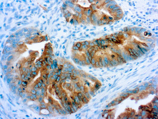 Formalin fixed paraffin embedded colon carcinoma stained with COX-2 antibody.