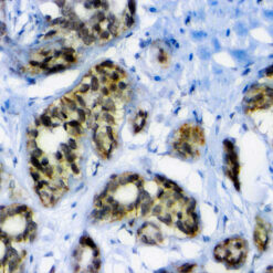 Formalin fixed paraffin embedded human Breast Carcinoma stained with BAP1