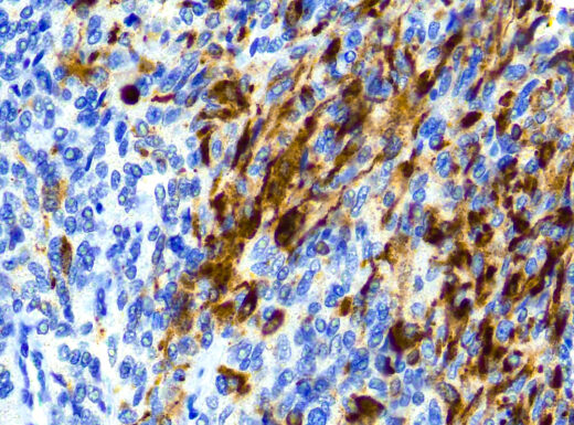 Formalin fixed paraffin embedded human Mesothelioma stained with Calretinin (H-5)