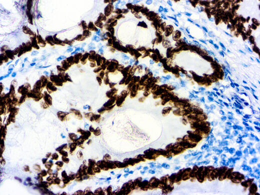 Formalin fixed paraffin embedded human colon carcinoma stained with SATB2