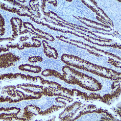 Formalin fixed paraffin embedded human colon carcinoma stained with SATB2