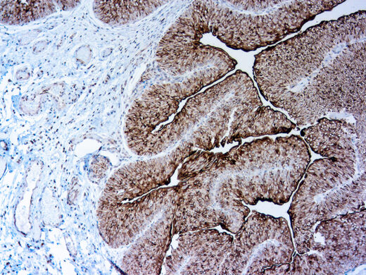 Formalin fixed paraffin embedded human Bladder carcinoma stained with UUroplakin III (AU1)