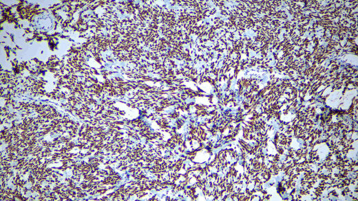 Formalin fixed paraffin embedded human Solitary fibrous tumor stained with STAT6