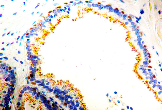 Formalin fixed paraffin embedded human Prostate stained with p63/p504s Cocktail.
