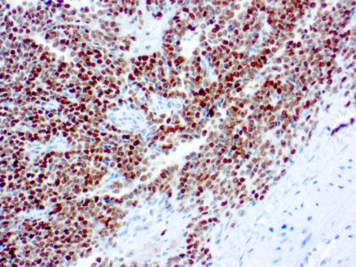 Formalin fixed paraffin embedded human Ewing’s sarcoma stained with NKX2.2.