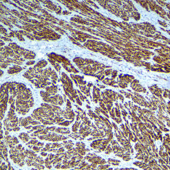 Formalin fixed paraffin embedded human Leiomyoma stained with Desmin (DE R 11)