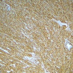 Formalin fixed paraffin embedded human GIST stained with CD117/c-kit