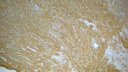 Formalin fixed paraffin embedded human GIST stained with CD117/c-kit