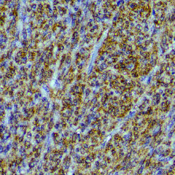 Formalin fixed paraffin embedded human GIST stained with CD117/c-kit