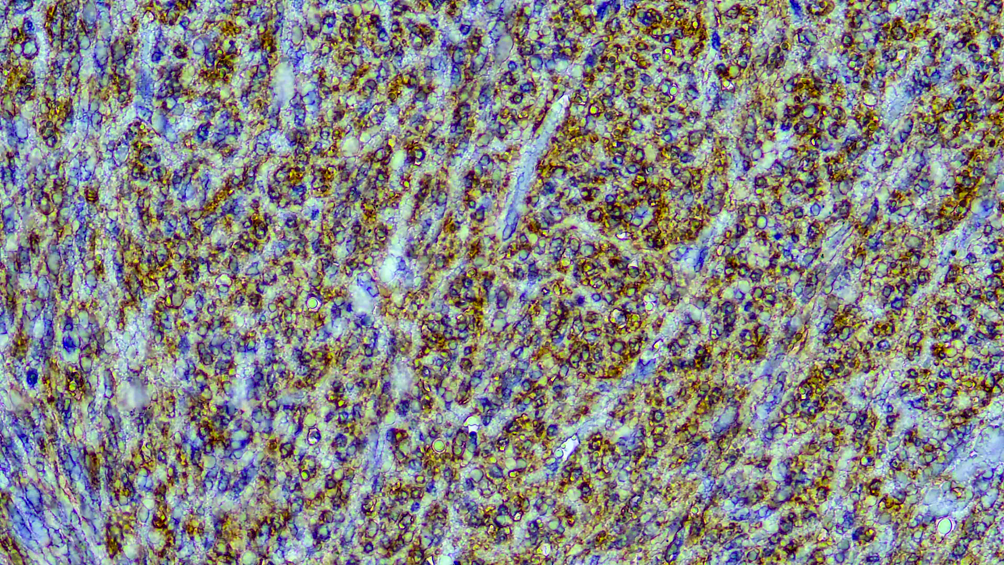 CD117/c-kit 1 Formalin fixed paraffin embedded human GIST stained with CD117/c-kit