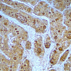 Formalin fixed paraffin embedded human esophageal carcinoma tissue stained with CEACAM5