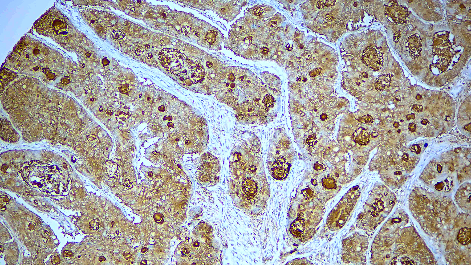 CEACAM5 1 Formalin fixed paraffin embedded human esophageal carcinoma tissue stained with CEACAM5