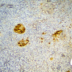 Formalin fixed paraffin embedded human esophageal carcinoma tissue stained with CEACAM5