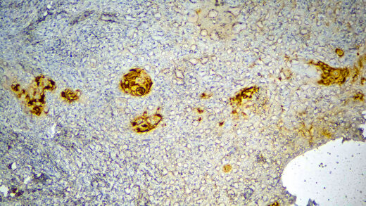 Formalin fixed paraffin embedded human esophageal carcinoma tissue stained with CEACAM5